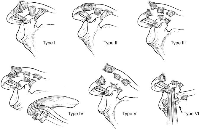 Rockwood classification of AC joint injuries, Types I to VI