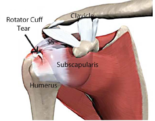 Anatomy of the shoulder showing a rotator cuff tear, the clavicle, subscapularis and humerus