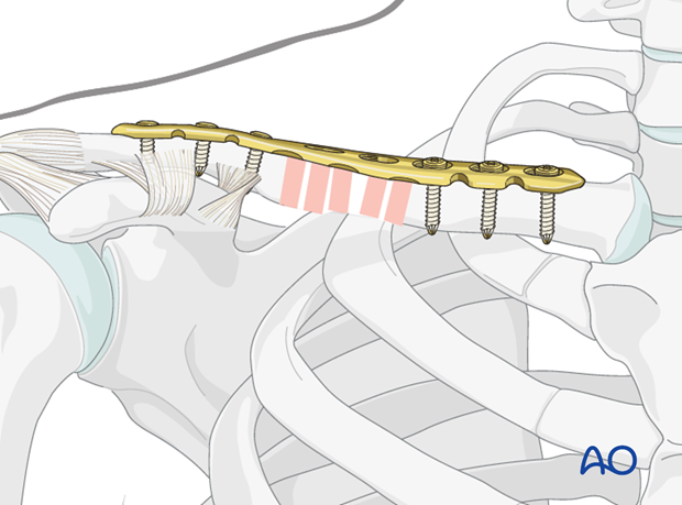 Clavicle fracture fixed with a plate and screws