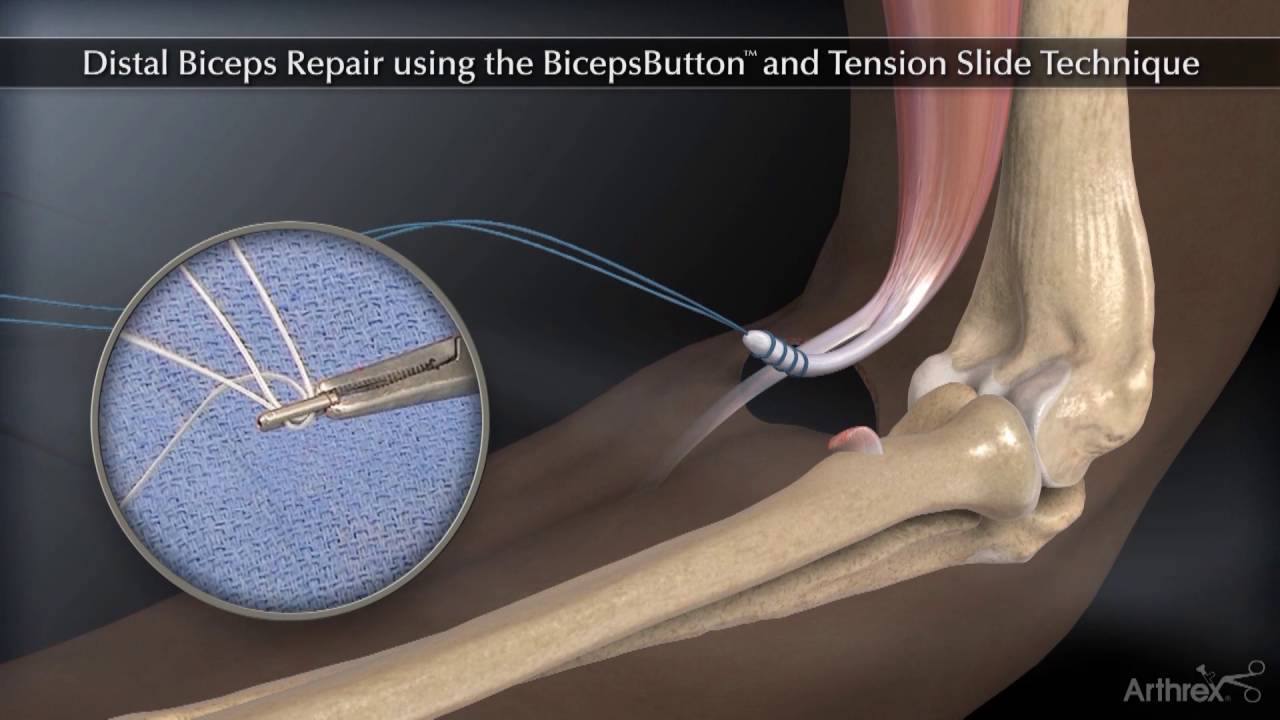Arthrex diagram: Distal Biceps Repair using the BicepsButton and Tension Slide Technique, showing the tendon reattached to the radius