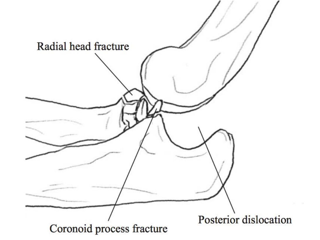 Diagram of a posteriorly dislocated elbow showing the radial head fracture and coronoid process fracture