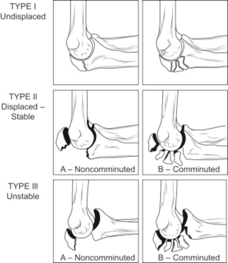 Olecranon fracture types: Type I undisplaced, Type II displaced and stable, Type III unstable, each non-comminuted or comminuted