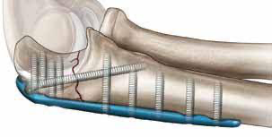 Olecranon fracture fixed with a plate and screws