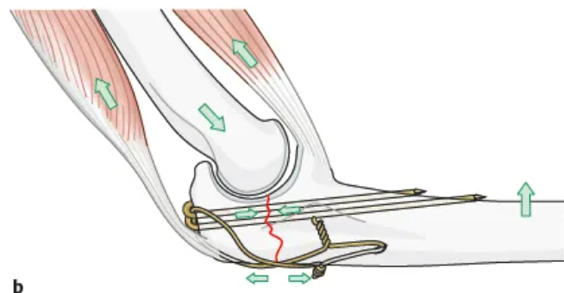 Olecranon fracture fixed with wires (tension band)