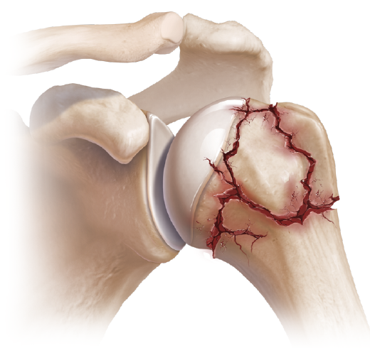 Illustration of a fractured proximal humerus at the shoulder joint